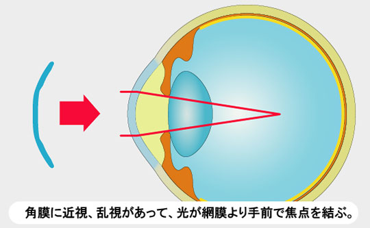 角膜に近視、乱視があって、光が網膜より手前で焦点を結ぶ